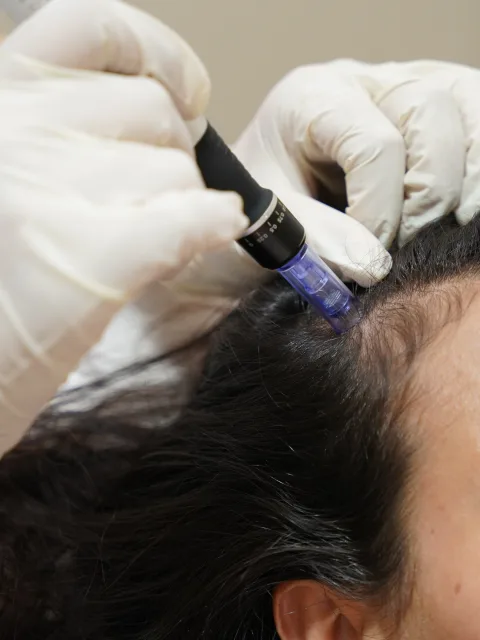 Microneedling cheveux Marrakech - traitement chute de cheveux Rosa Alba Beauty